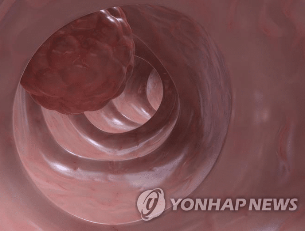 암 알츠하이머 관계